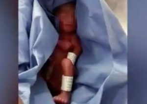 Bebé de 5 meses de gestación nació pero lo dieron por muerto, dos horas después “resucitó” (Video)