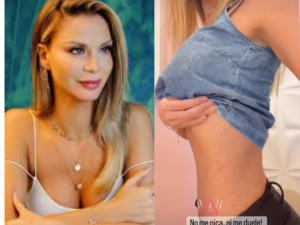 Dijeron que Egny Eckert tiene viruela del mono y ella aclaró: “Fue una alergia”