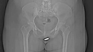 ¡Escándalo! Una joven mujer recibió un balazo en sus partes intimas