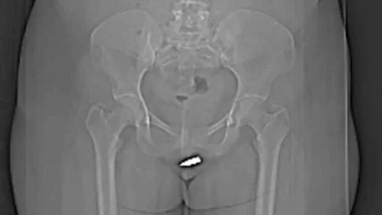 ¡Escándalo! Una joven mujer recibió un balazo en sus partes intimas