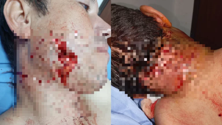 Hombre quedó desfigurado upéi de que un feroz jagua le arrancó la piel de su rostro