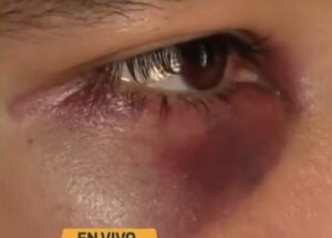 (Video) “Por celos”, un alumno del CTN dejó con el ojo morado a otro estudiante