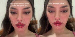 (VIDEO) ¿Qué piko le pasó? ¡Panelista de tevé apareció así en sus redes!
