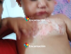 Cambyretá: Bebé sufre graves quemaduras, supuestamente le daban de vapear