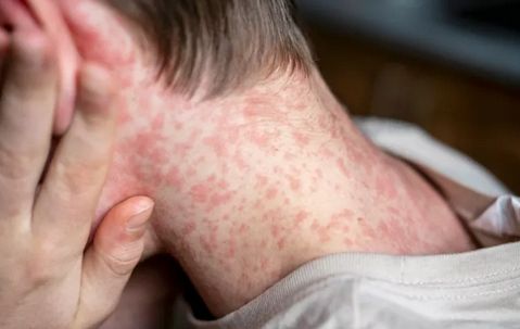 Oima siete casos confirmados de sarampión en nuestro terruño