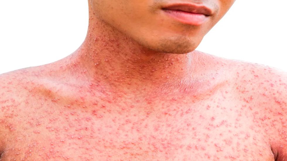 Ojupi jey casos de sarampión: Confirman otros tres casos en San Pedro