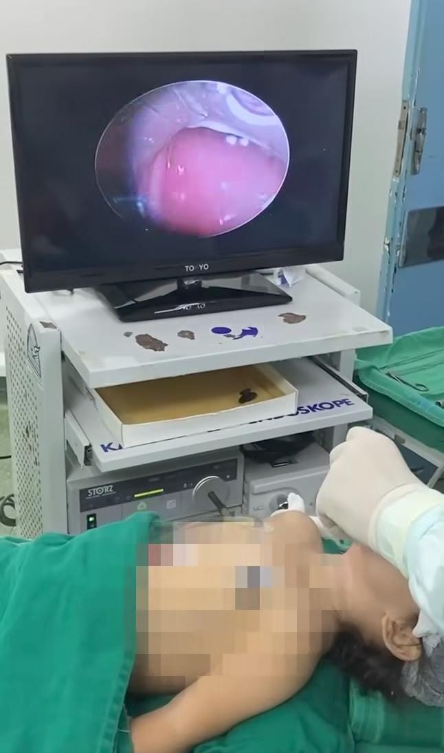 Niña de 2 años está grave y en terapia intensiva por culpa de una maní