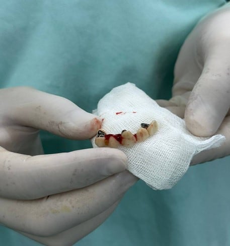 Un hombre fue tratado por asma, pero había sido se tragó una paladar