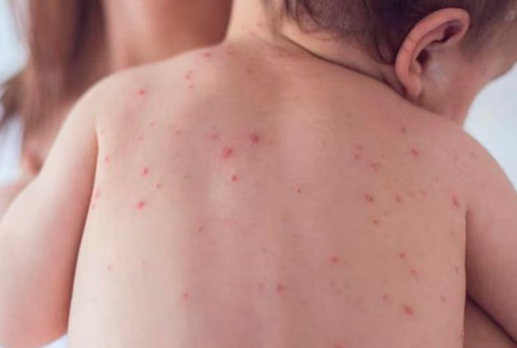 ¡Ndi bárbaro! Salud he’i que tienen confirmados 49 casos de sarampión