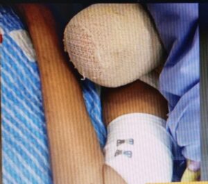 Denuncia de supuesta negligencia en el Hospital de Villa Hayes: Le fracturaron su pierna a una doñita que ingresó para amputación