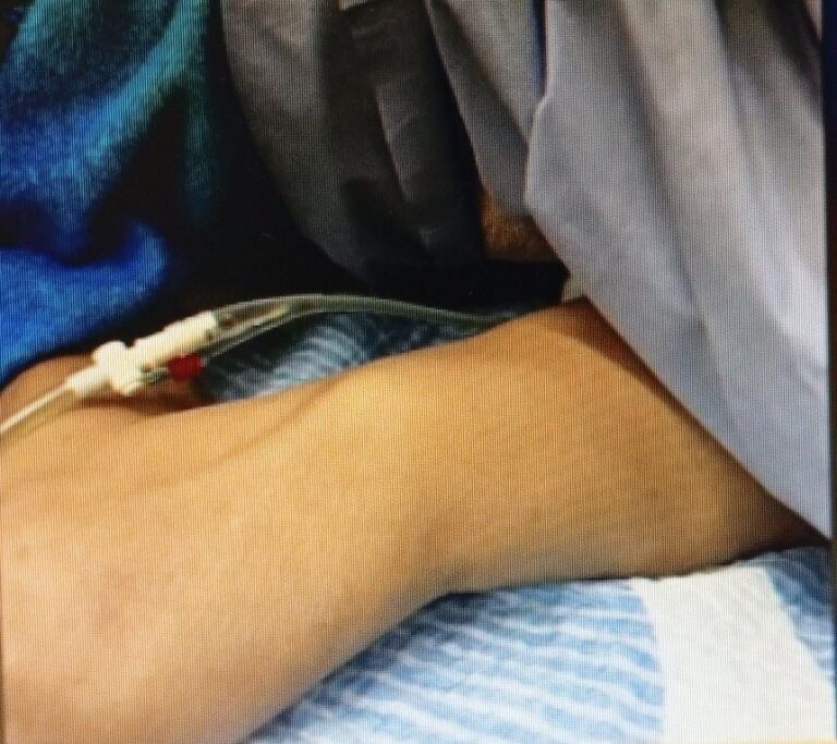 Denuncia de supuesta negligencia en el Hospital de Villa Hayes: Le fracturaron su pierna a una doñita que ingresó para amputación