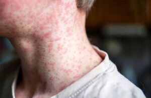 Sarampión: Hay casos sospechosos y 49 enfermos confirmados