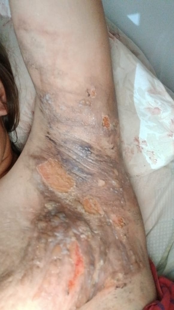 Suegra derramó agua hirviendo a su nuera