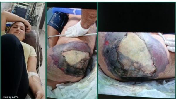 Denuncian que inyección perforó vaso de joven de 19 años y la mandó al otro mundo