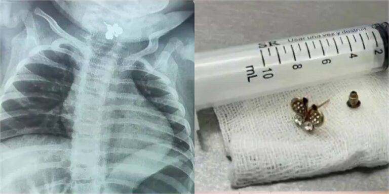 Bebé de 10 meses tragó un arito y fue operada de urgencia en Paraguay