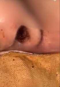 Doñita internada en UTI de IPS Ingavi oreko larvas en la nariz