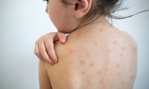 measles-su19-300x180.jpg