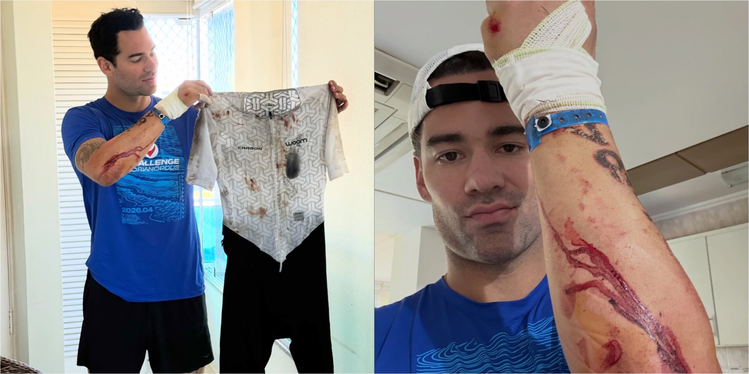 (GALERÍA) Renato Prono y un feo accidente: “Feliz de poder estar contando la historia”