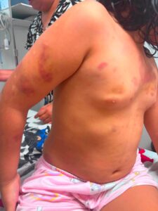 Imputaron a la mamá de niña torturada por padrastro