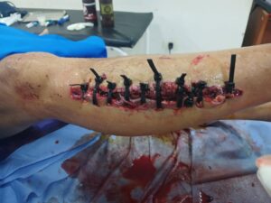 ¡Indignación! Le suturaron su hetyma con cintillo de plástico