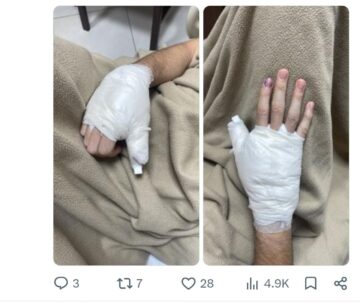 Arquero del Trico casi perdió un dedo ra´e